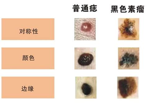 接合痣|皮膚科王修含醫師: 痣與黑色素細胞癌